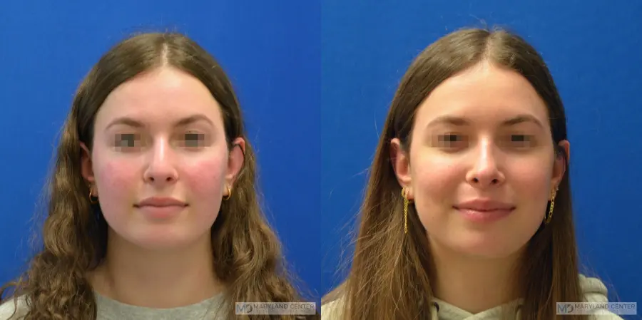 Rhinoplasty: Patient 8 - Before and After  