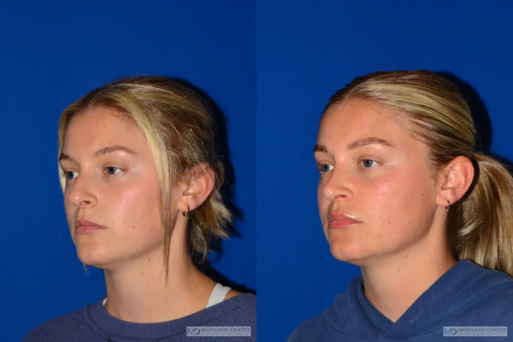 Rhinoplasty: Patient 7 - Before and After 4