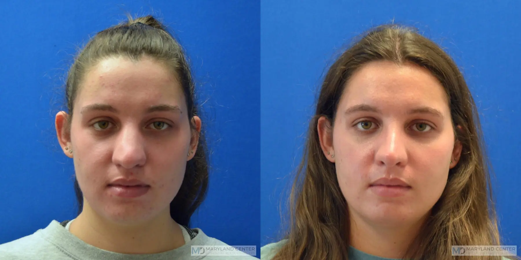 Rhinoplasty: Patient 6 - Before and After  