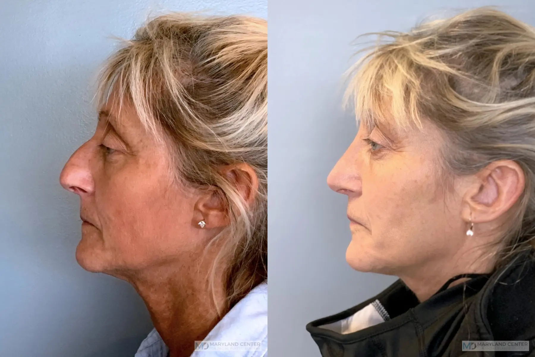 Rhinoplasty: Patient 18 - Before and After 2