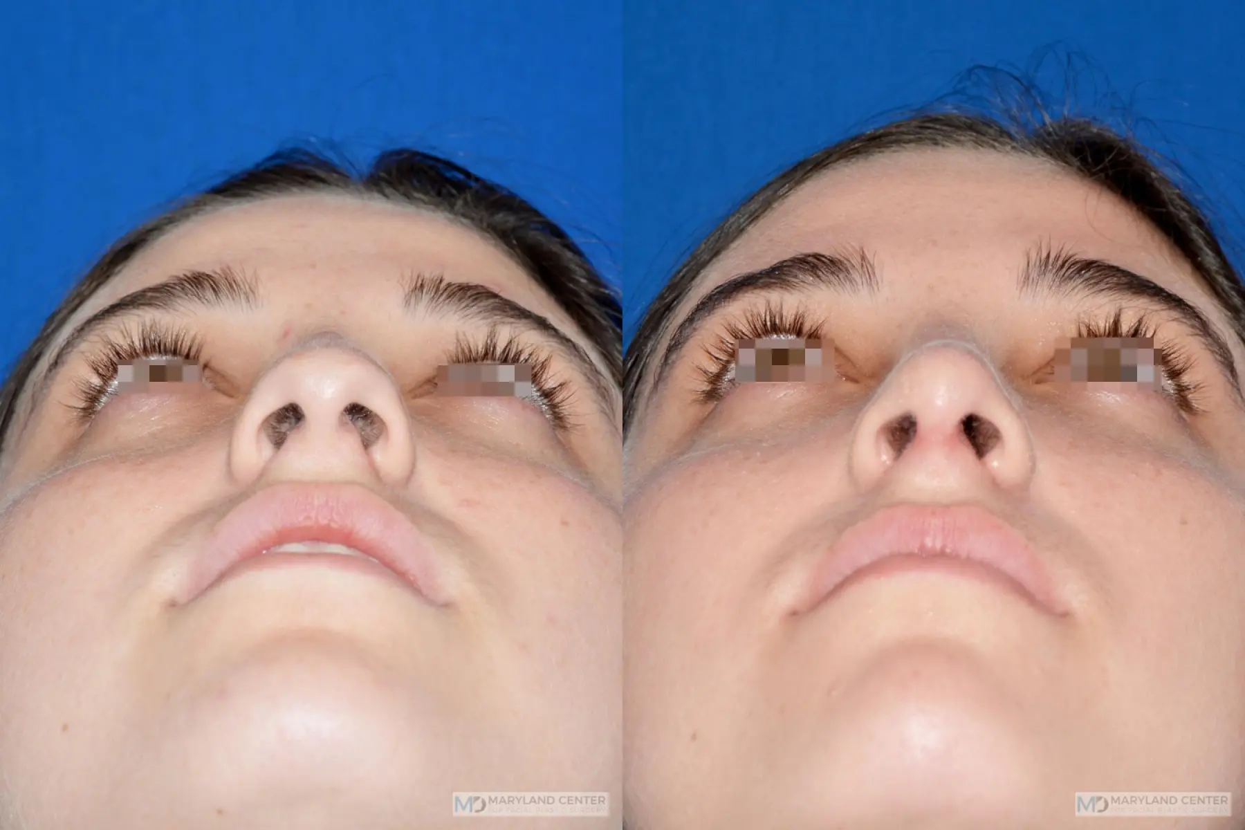 Rhinoplasty: Patient 17 - Before and After 4