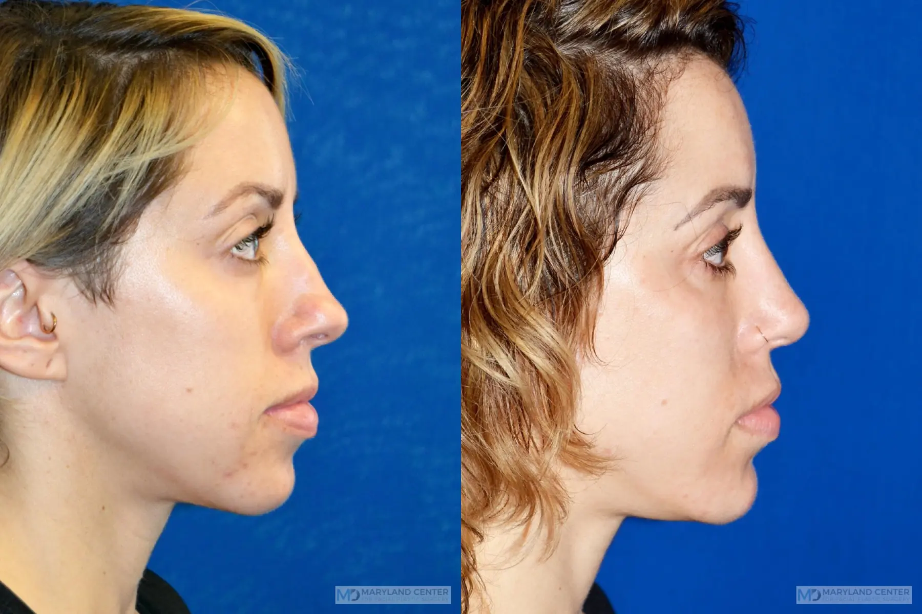 Rhinoplasty: Patient 19 - Before and After 2