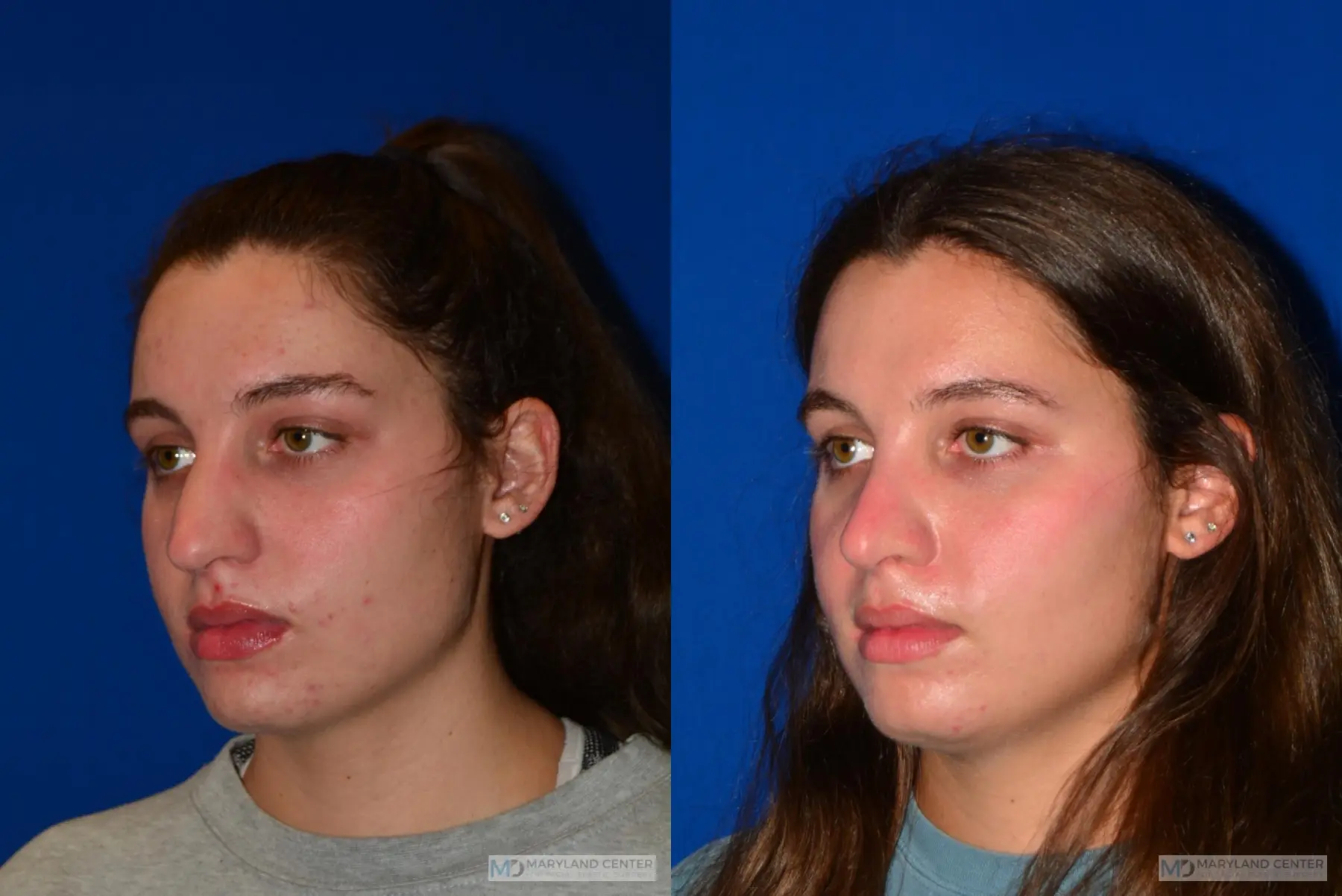 Rhinoplasty: Patient 16 - Before and After 4