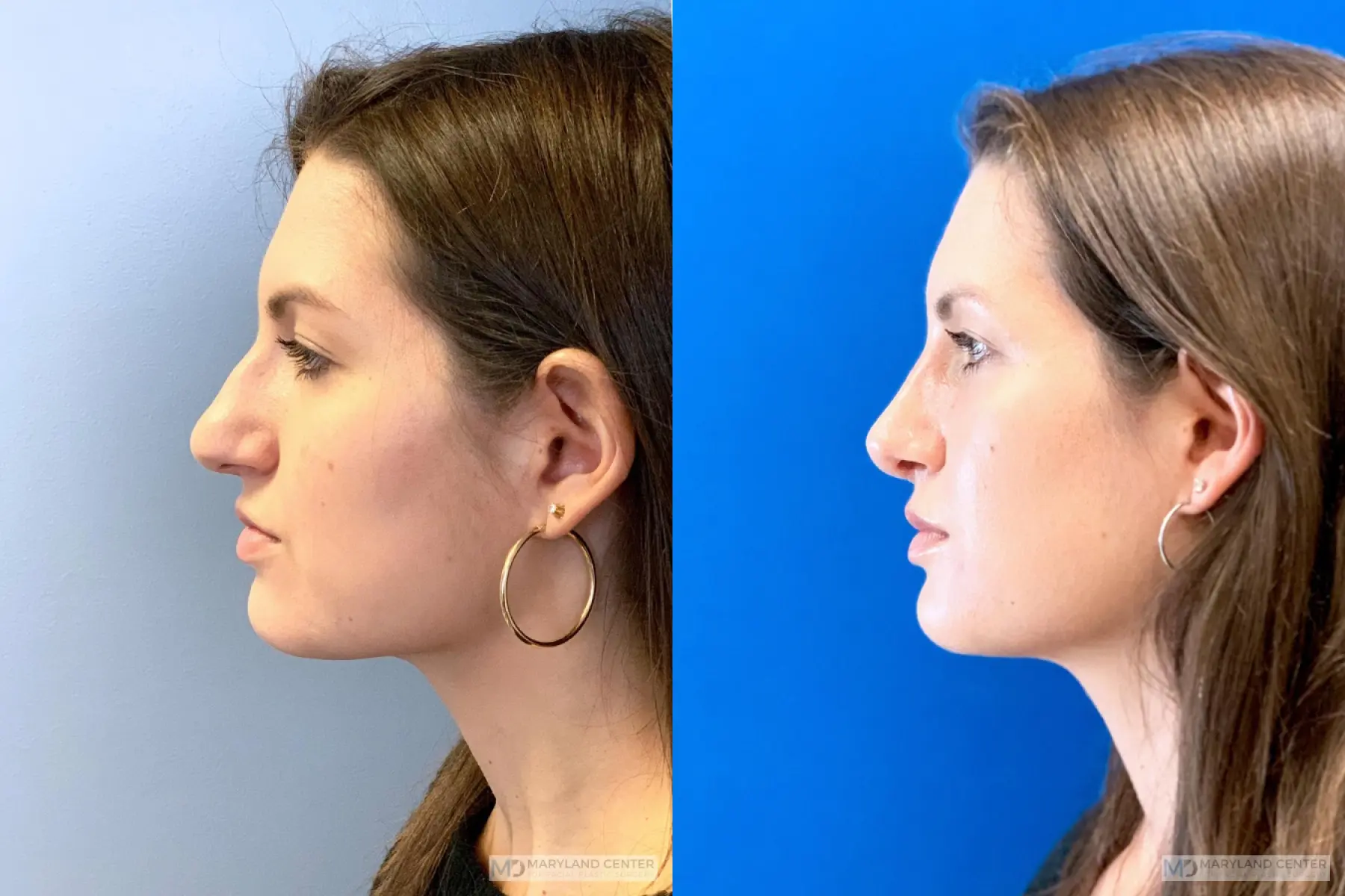 Rhinoplasty: Patient 9 - Before and After 2