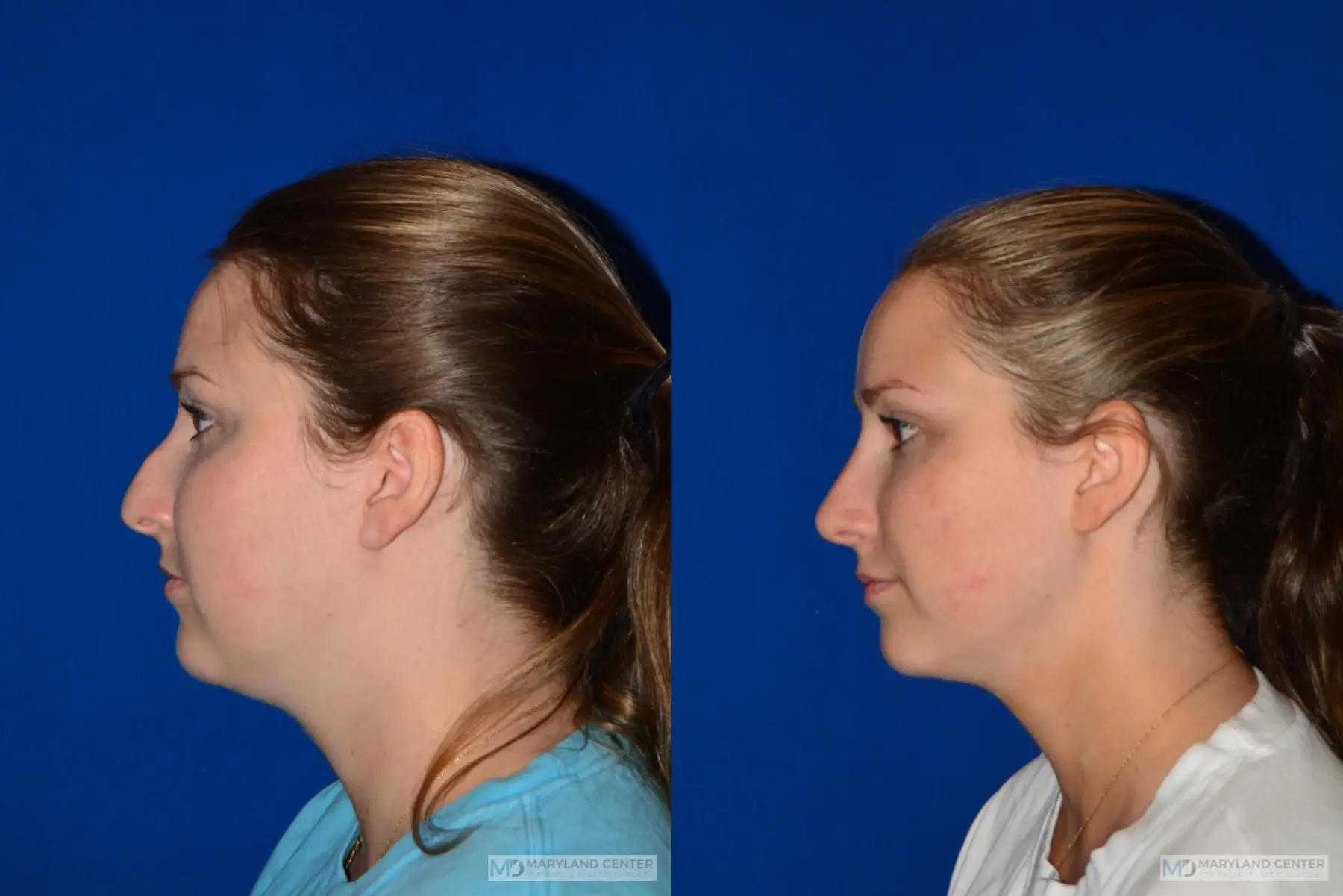 Rhinoplasty: Patient 1 - Before and After 2
