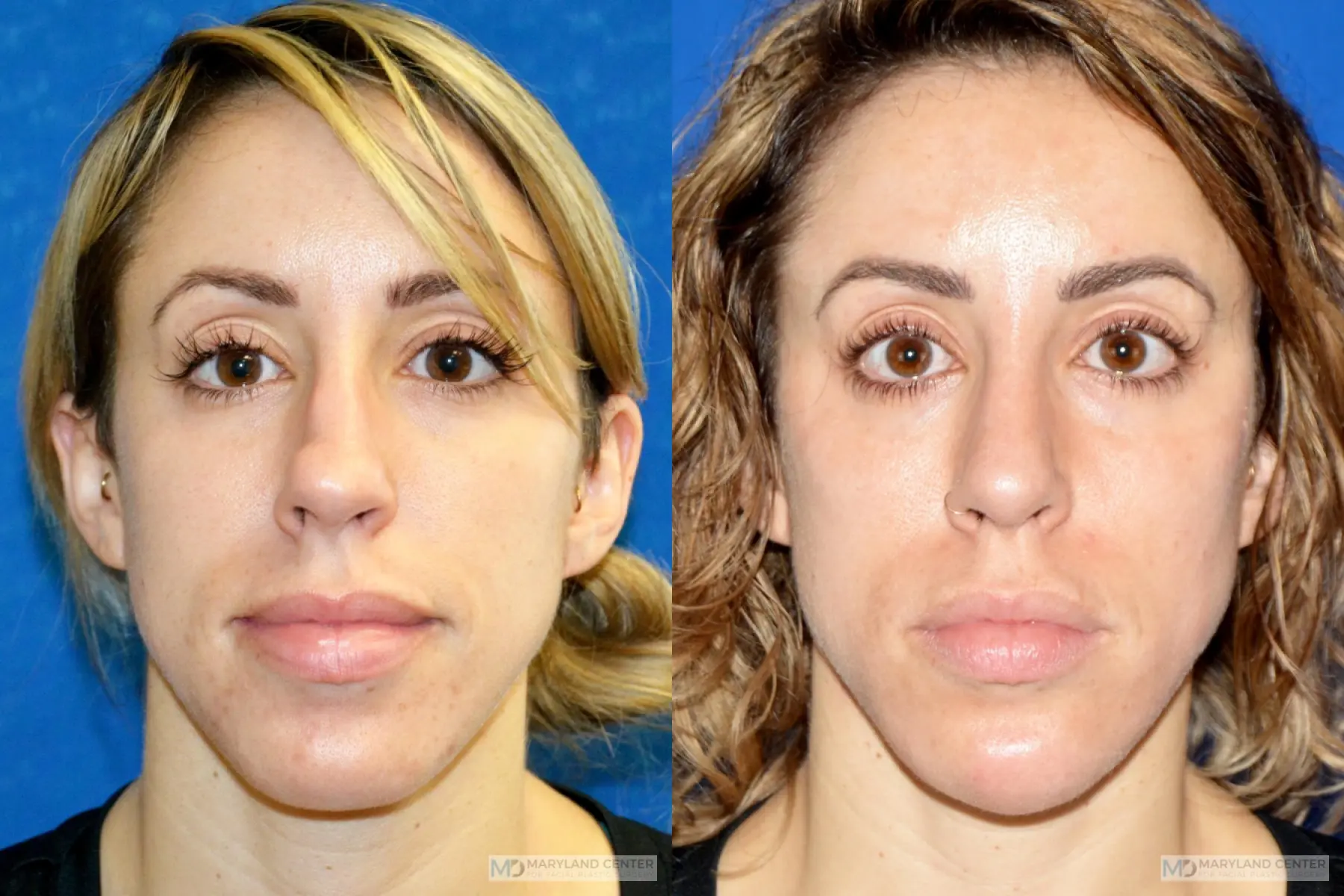 Rhinoplasty: Patient 19 - Before and After  