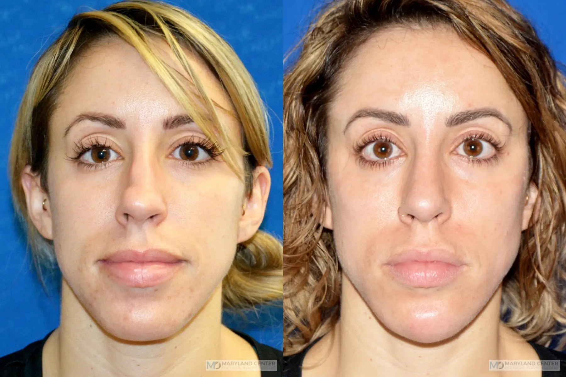 Rhinoplasty: Patient 19 - Before and After 1