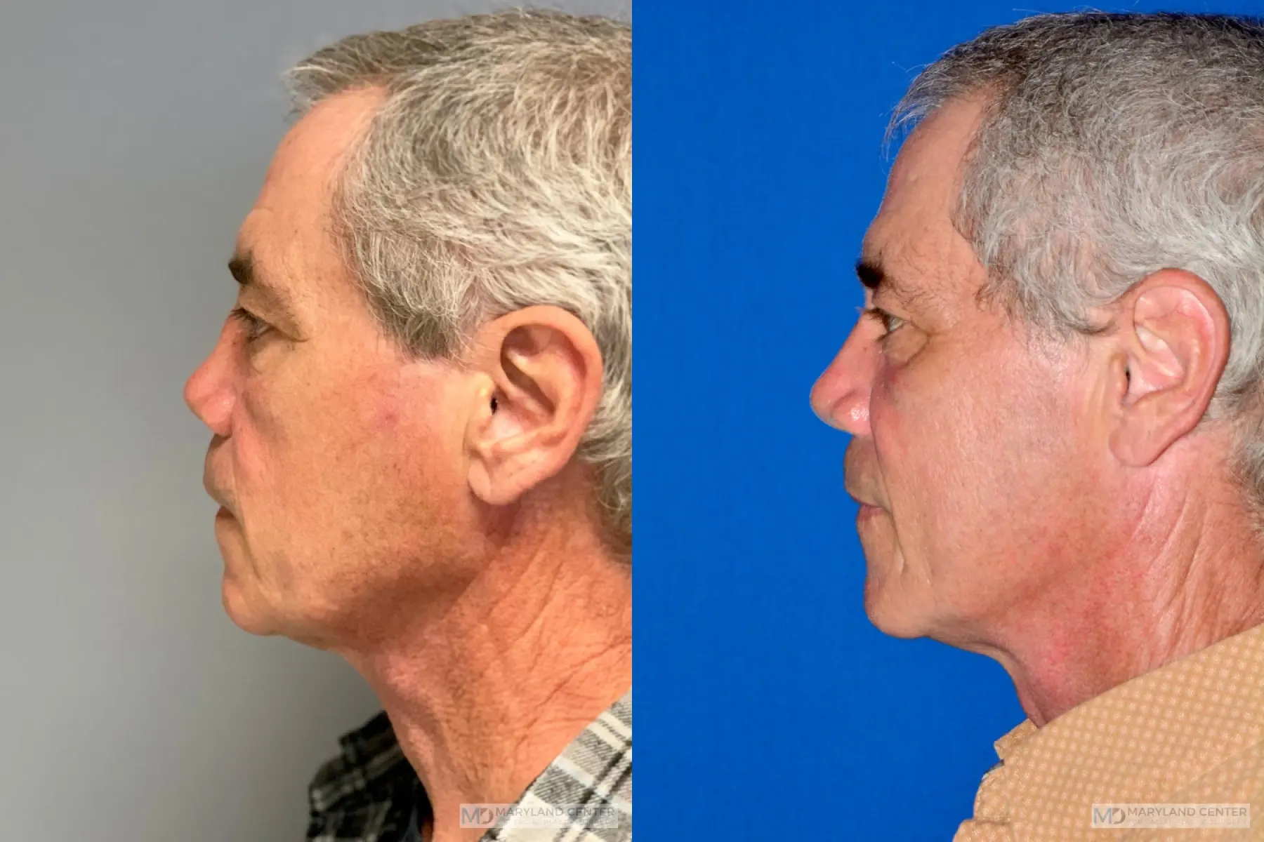Rhinoplasty: Patient 20 - Before and After 2