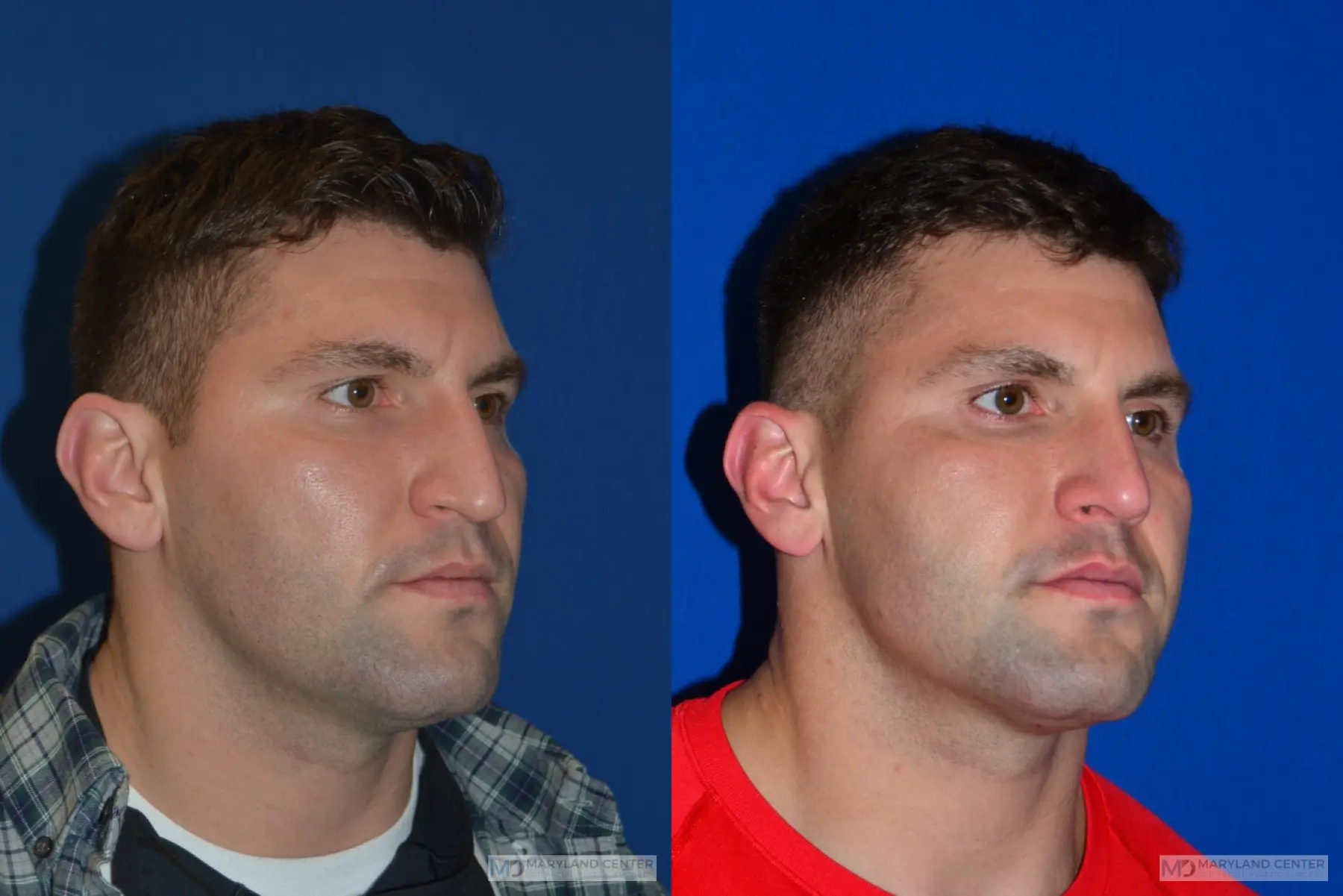 Rhinoplasty: Patient 8 - Before and After 5