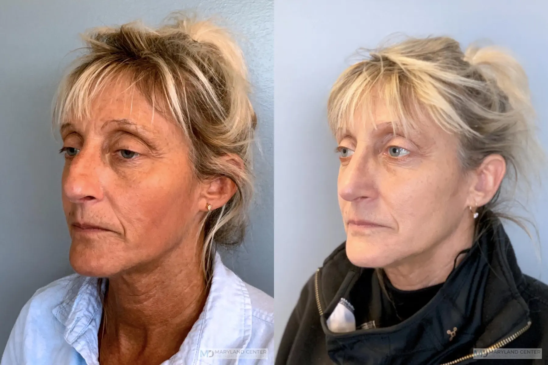 Rhinoplasty: Patient 18 - Before and After 3