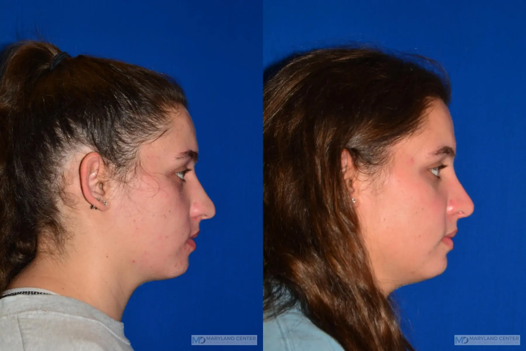 Rhinoplasty: Patient 16 - Before and After 3