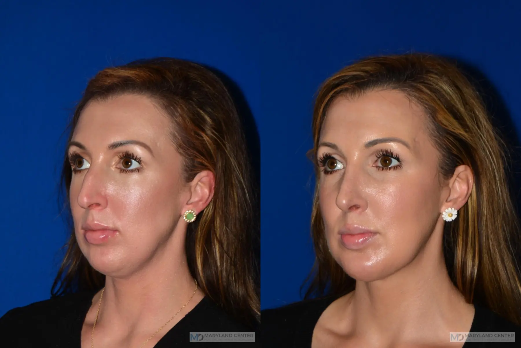 Rhinoplasty: Patient 2 - Before and After 3
