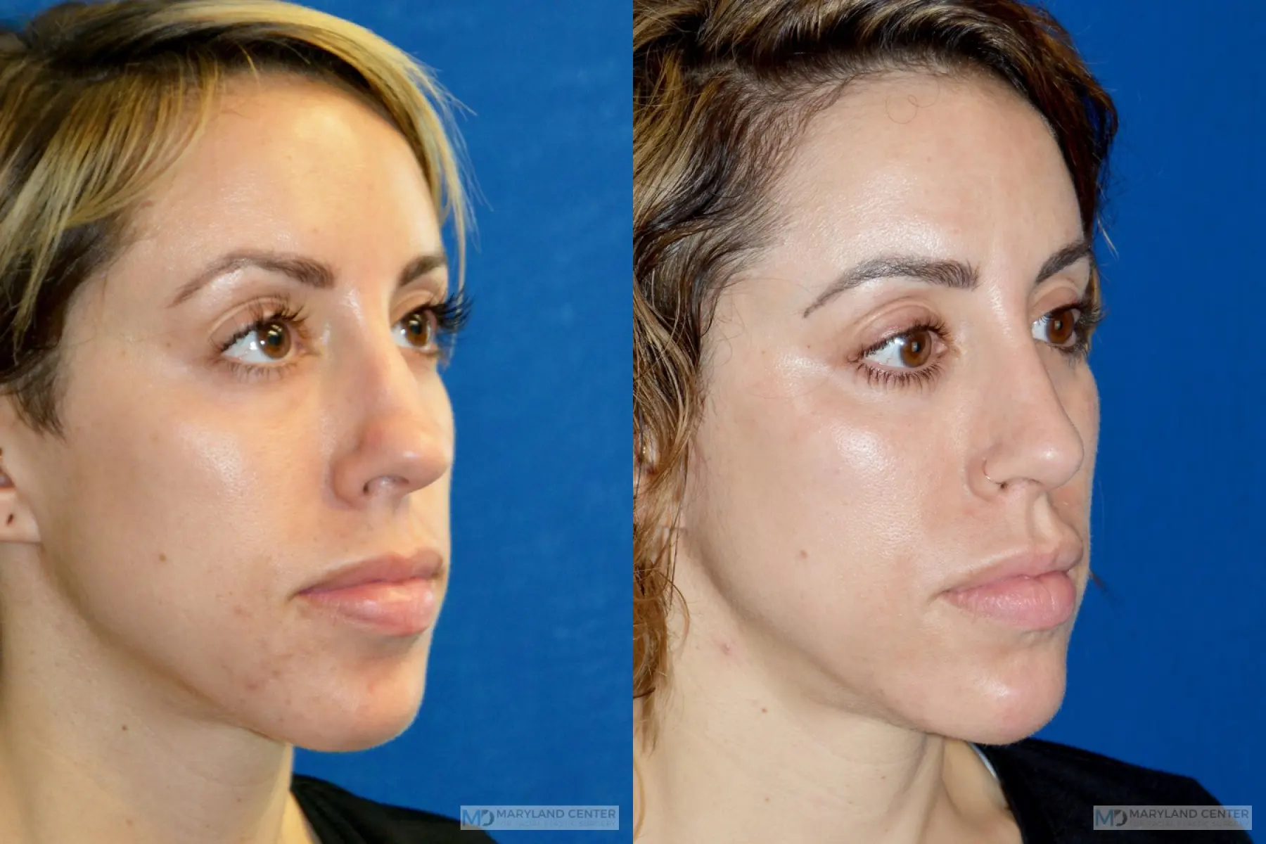 Rhinoplasty: Patient 19 - Before and After 3