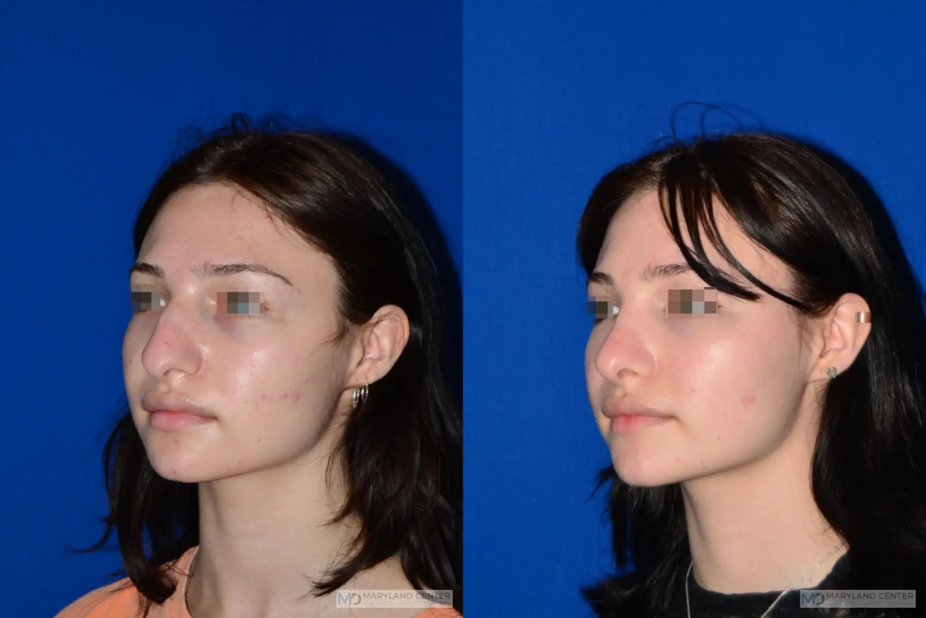 Rhinoplasty: Patient 4 - Before and After 3