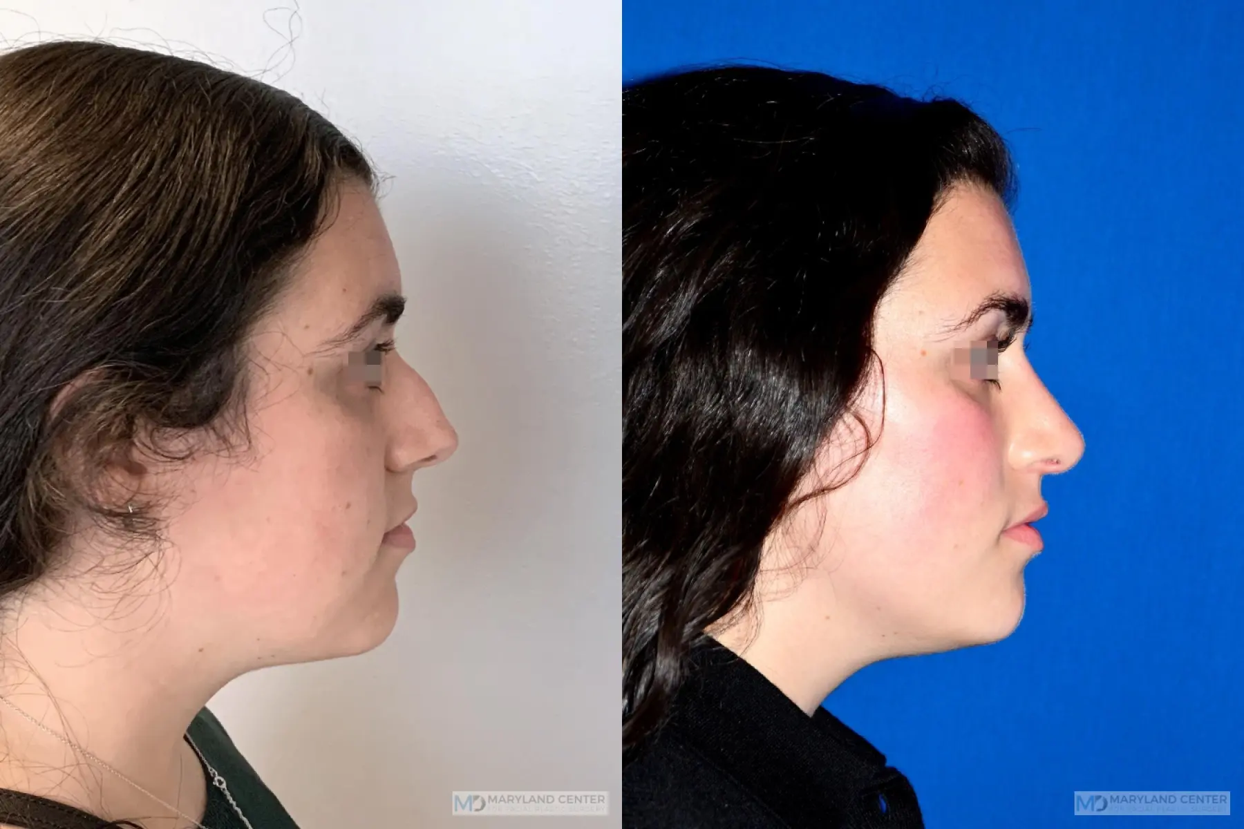 Rhinoplasty: Patient 3 - Before and After 2