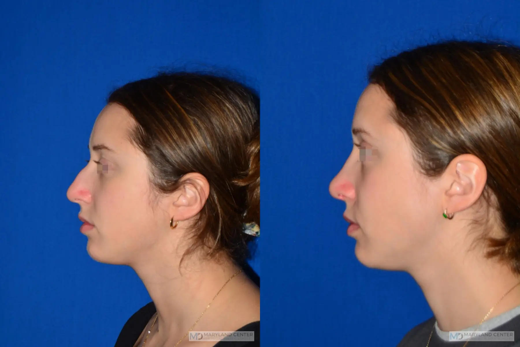 Rhinoplasty: Patient 5 - Before and After 2