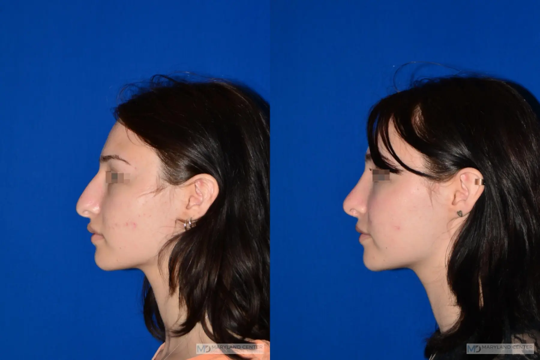 Rhinoplasty: Patient 4 - Before and After 2
