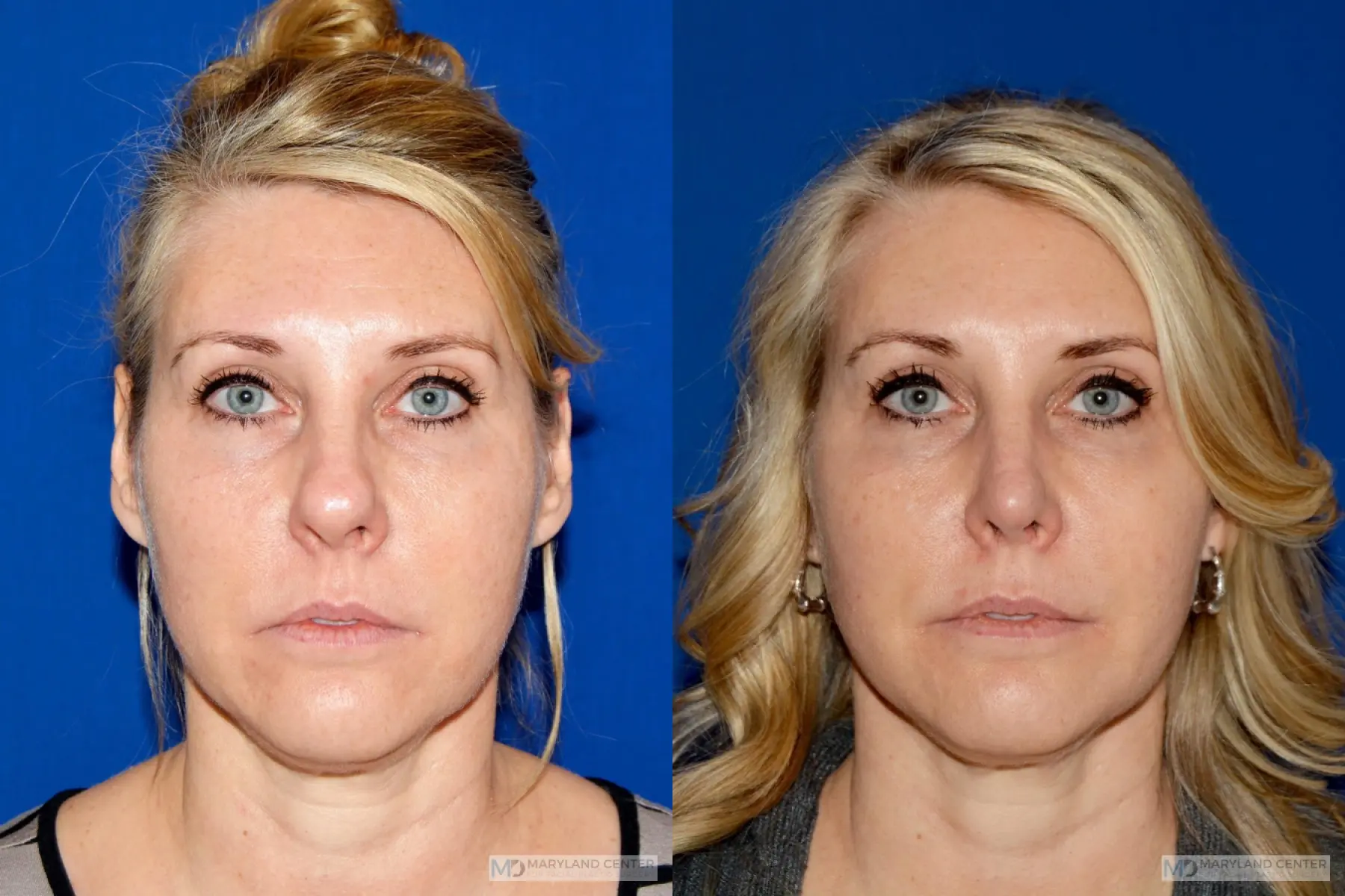 Rhinoplasty: Patient 15 - Before and After 1
