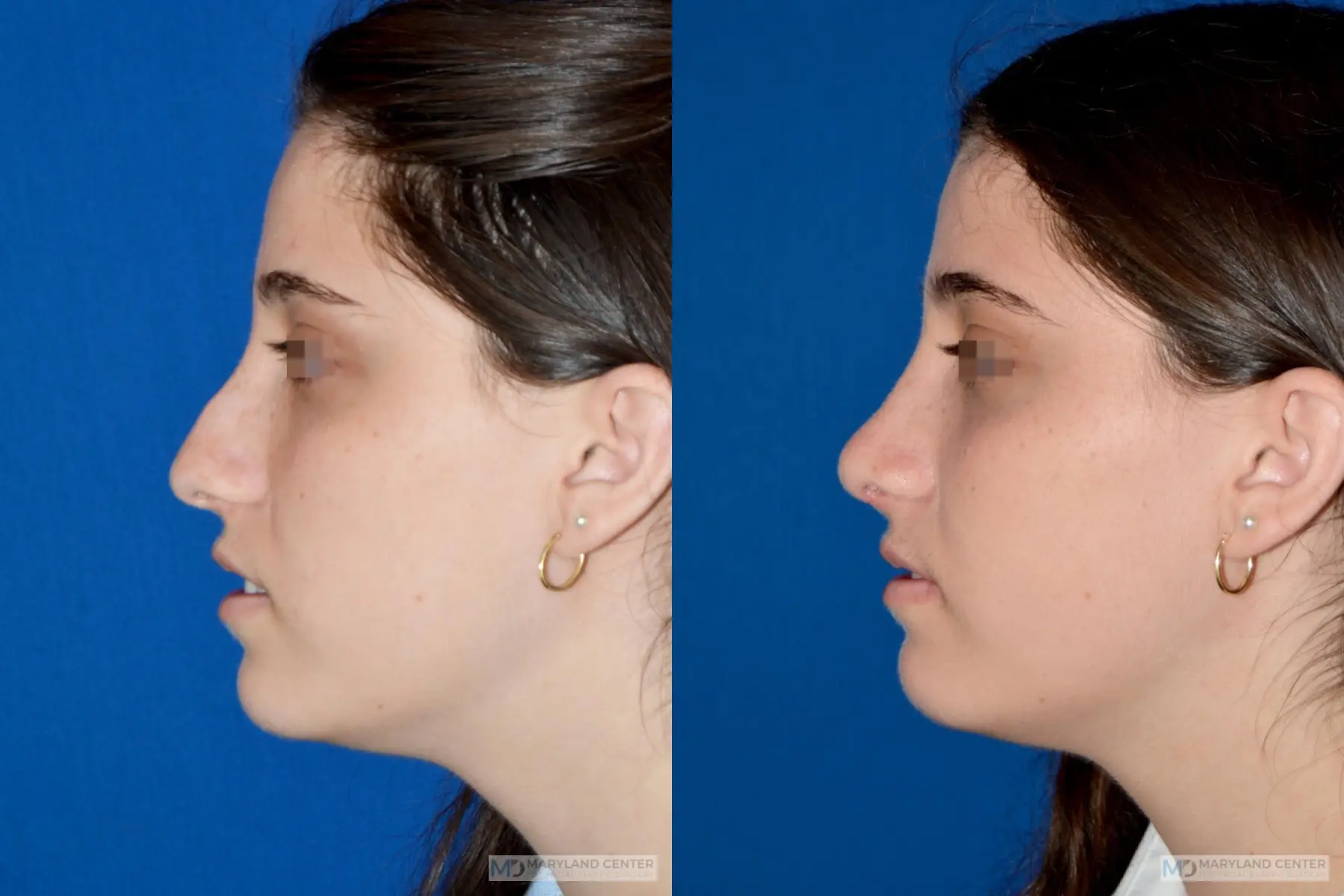 Rhinoplasty: Patient 17 - Before and After 2