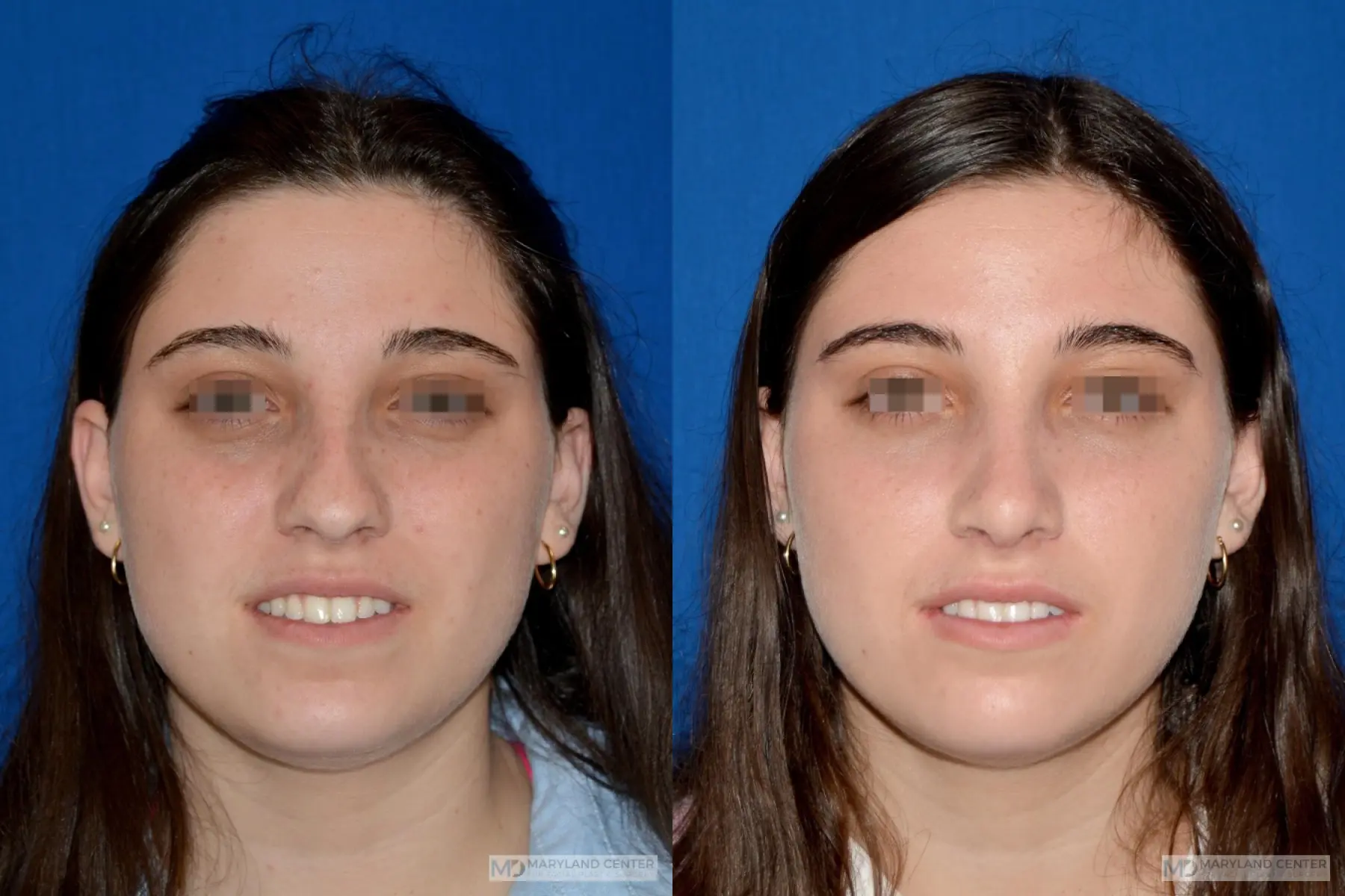 Rhinoplasty: Patient 17 - Before and After 1