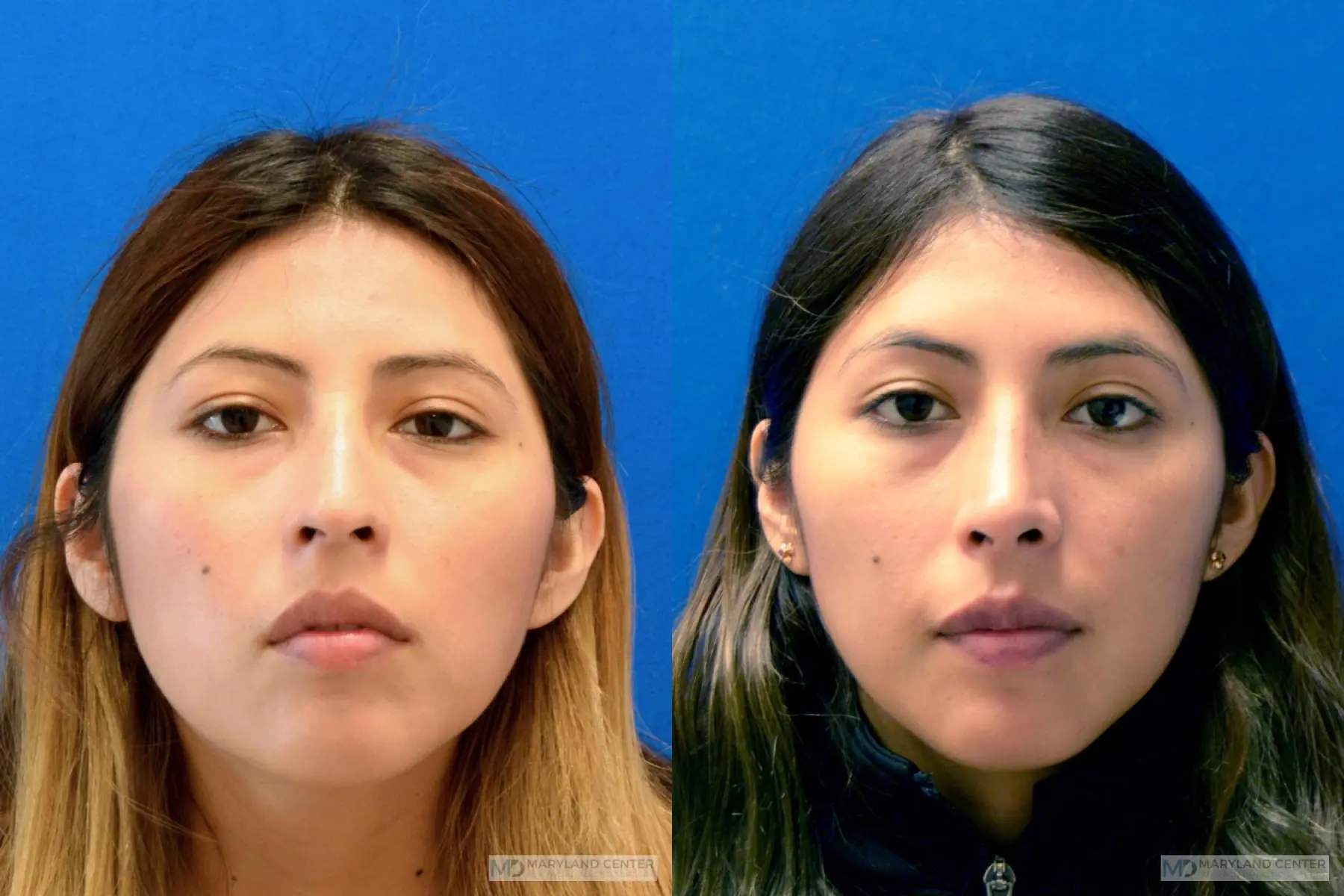 Rhinoplasty: Patient 10 - Before and After  