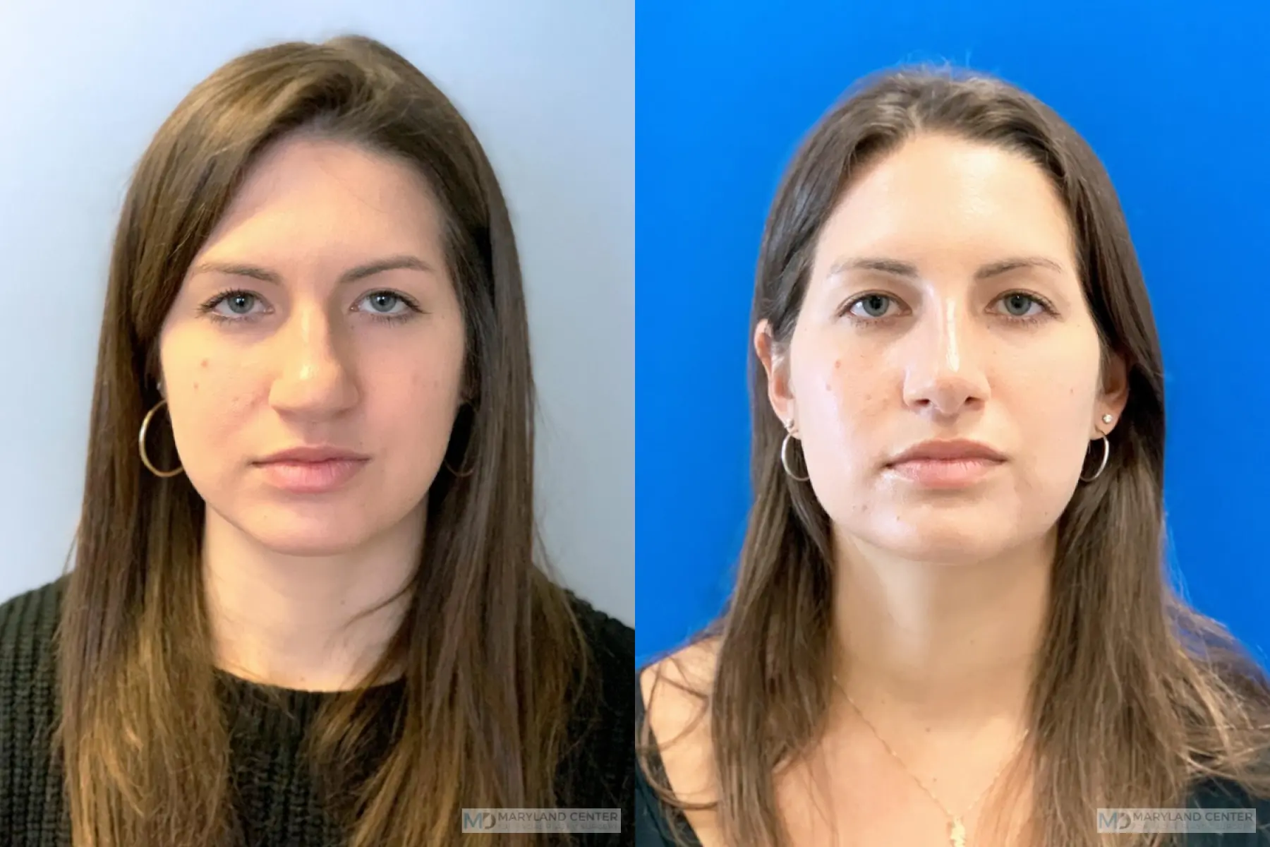Rhinoplasty: Patient 9 - Before and After 1