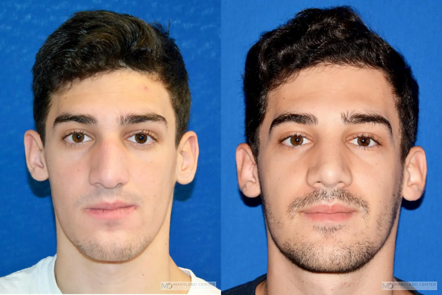 Rhinoplasty: Patient 10 - Before and After  