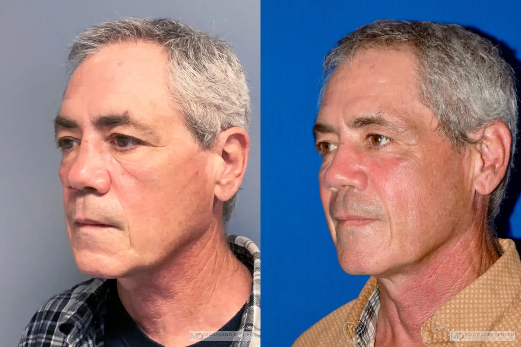 Rhinoplasty: Patient 20 - Before and After 3