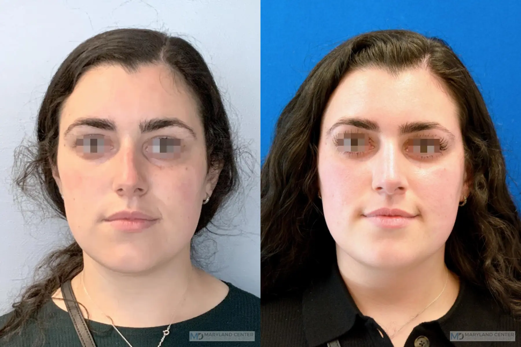 Rhinoplasty: Patient 3 - Before and After  