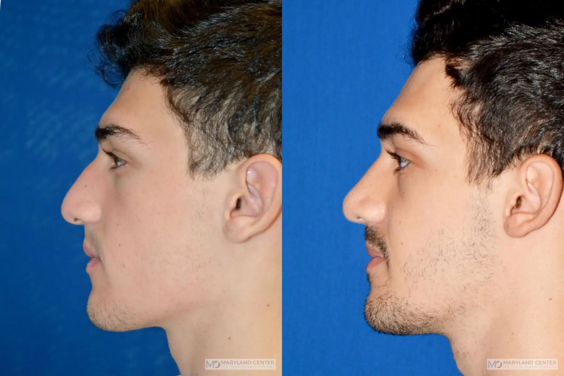 Rhinoplasty: Patient 14 - Before and After 2
