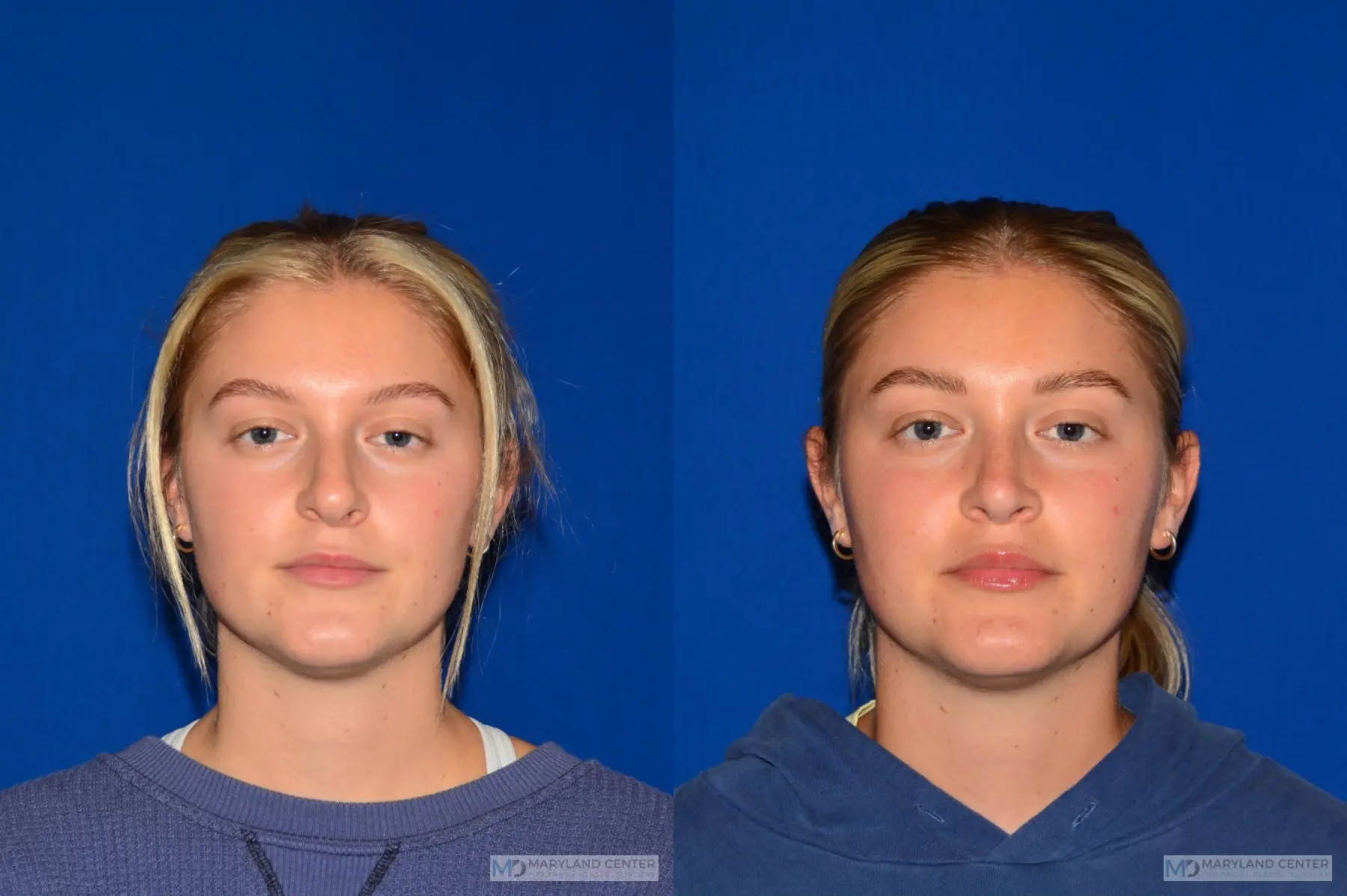 Rhinoplasty: Patient 7 - Before and After  