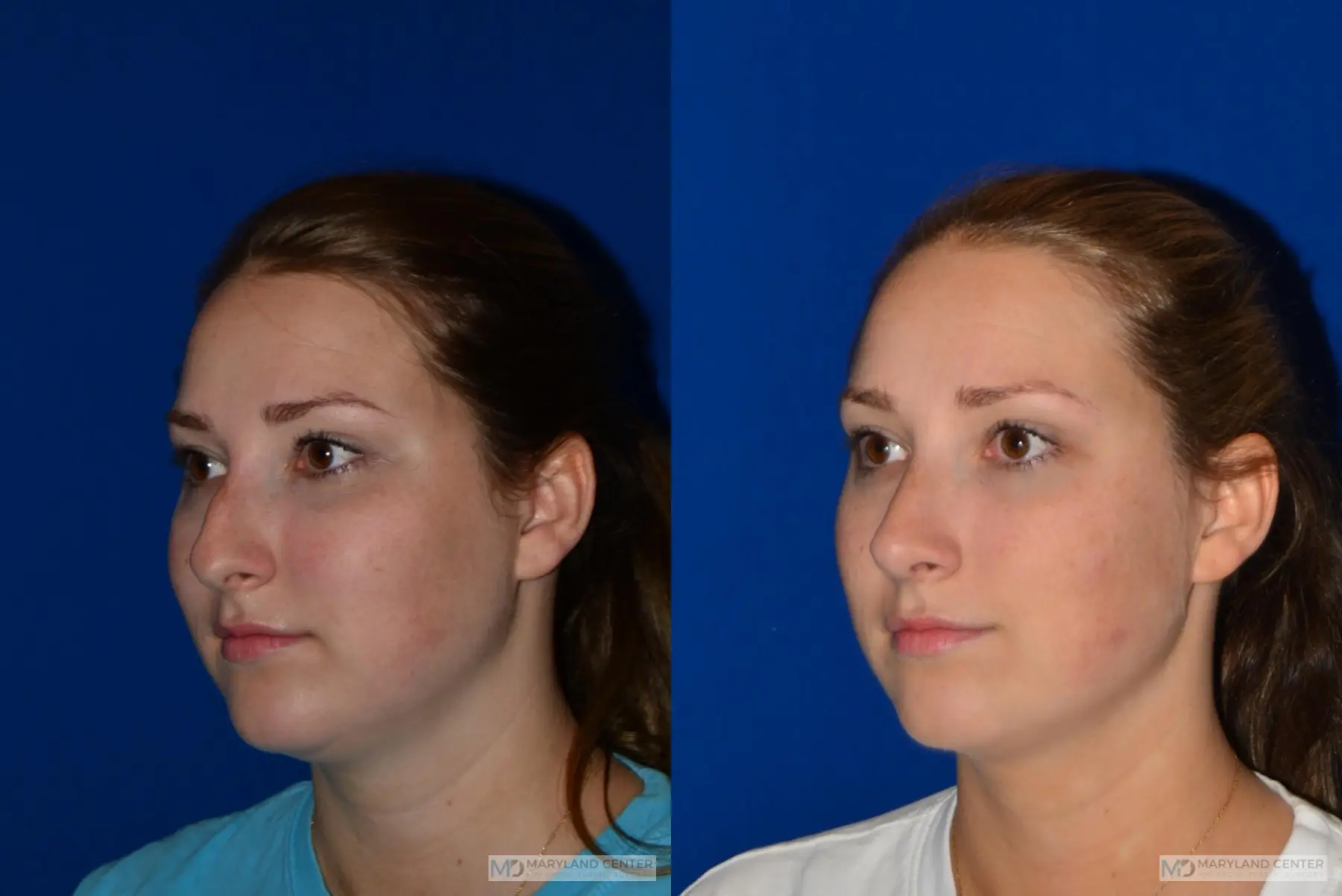 Rhinoplasty: Patient 1 - Before and After 3