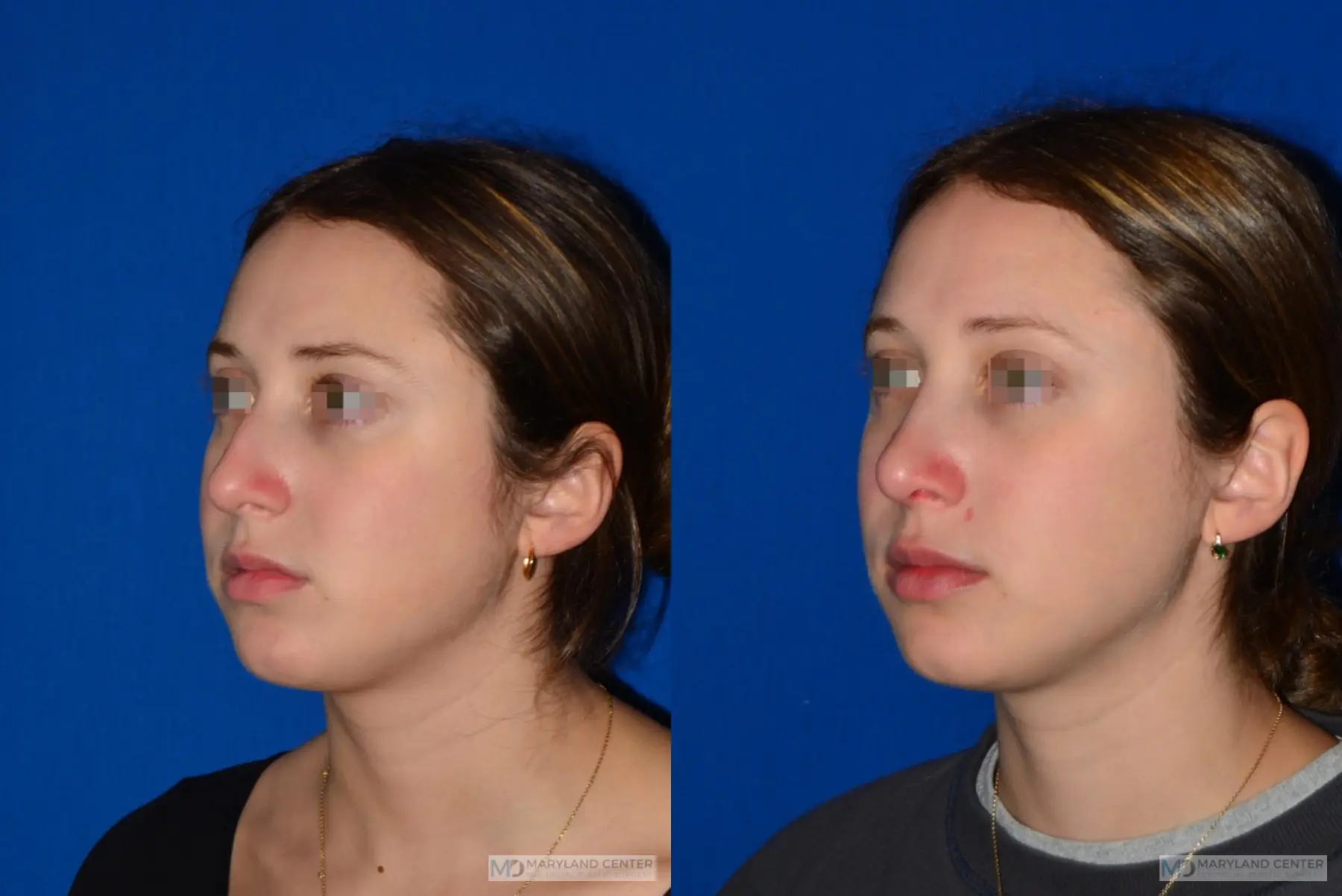 Rhinoplasty: Patient 5 - Before and After 3