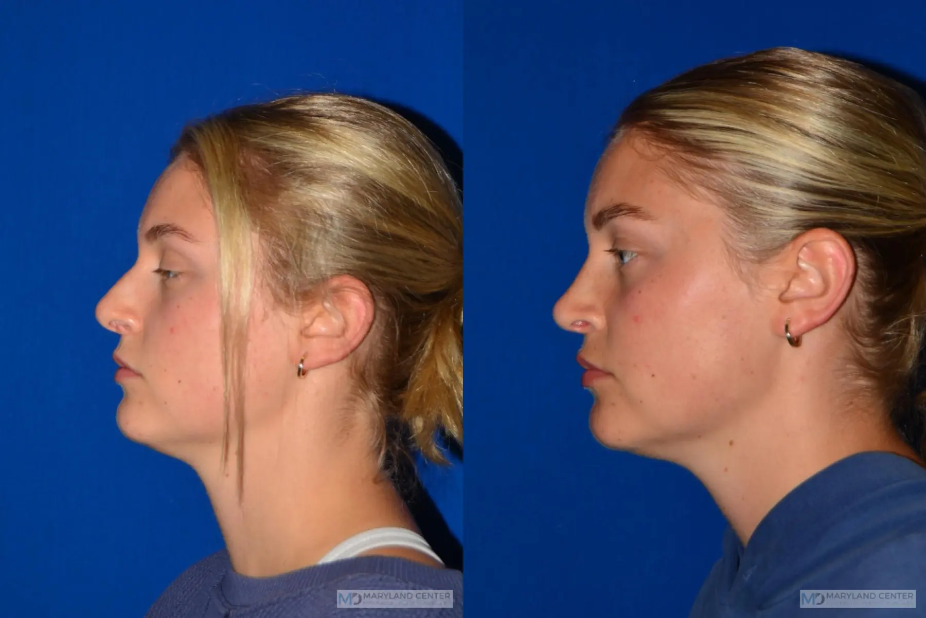 Rhinoplasty: Patient 7 - Before and After 3