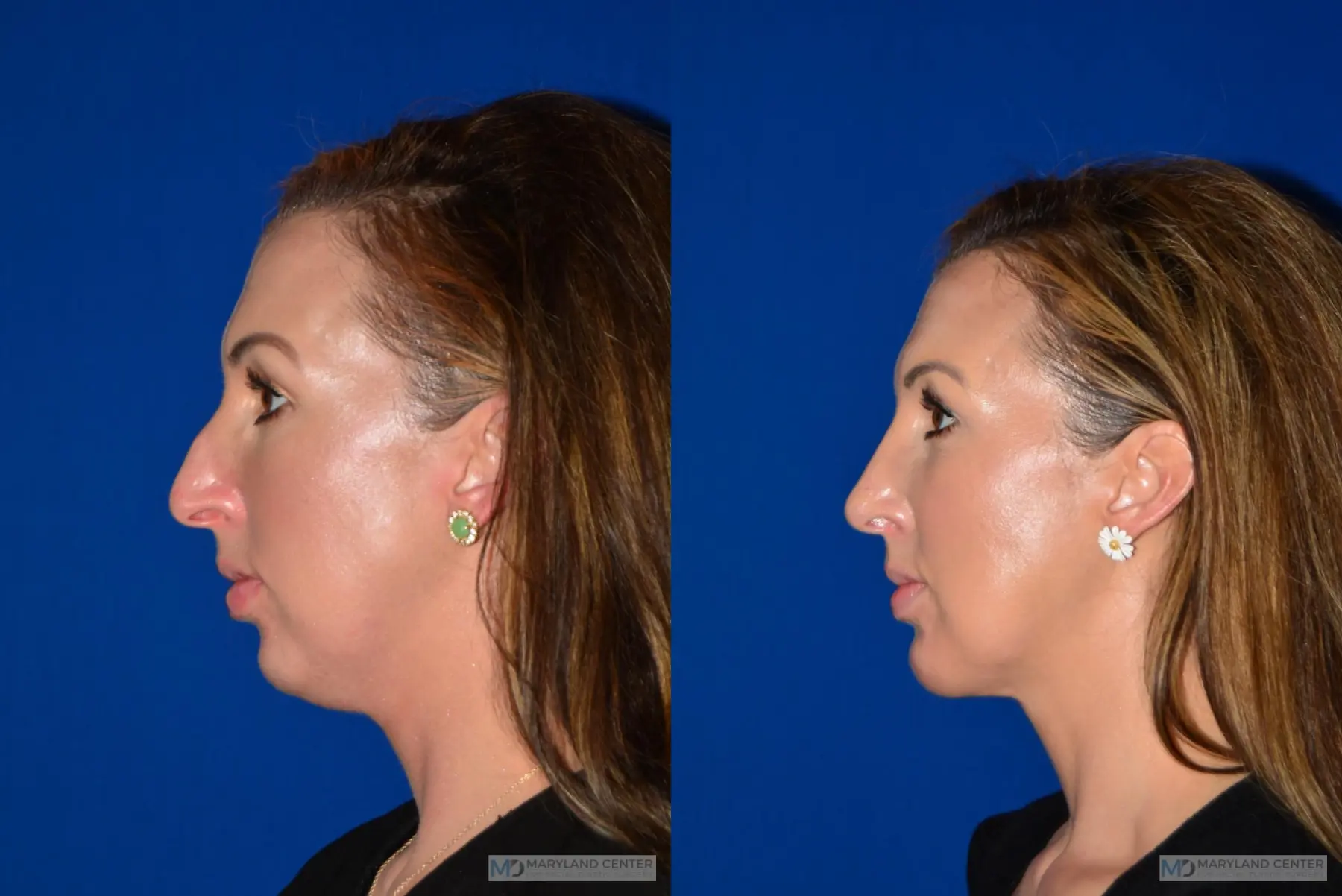 Rhinoplasty: Patient 2 - Before and After 2