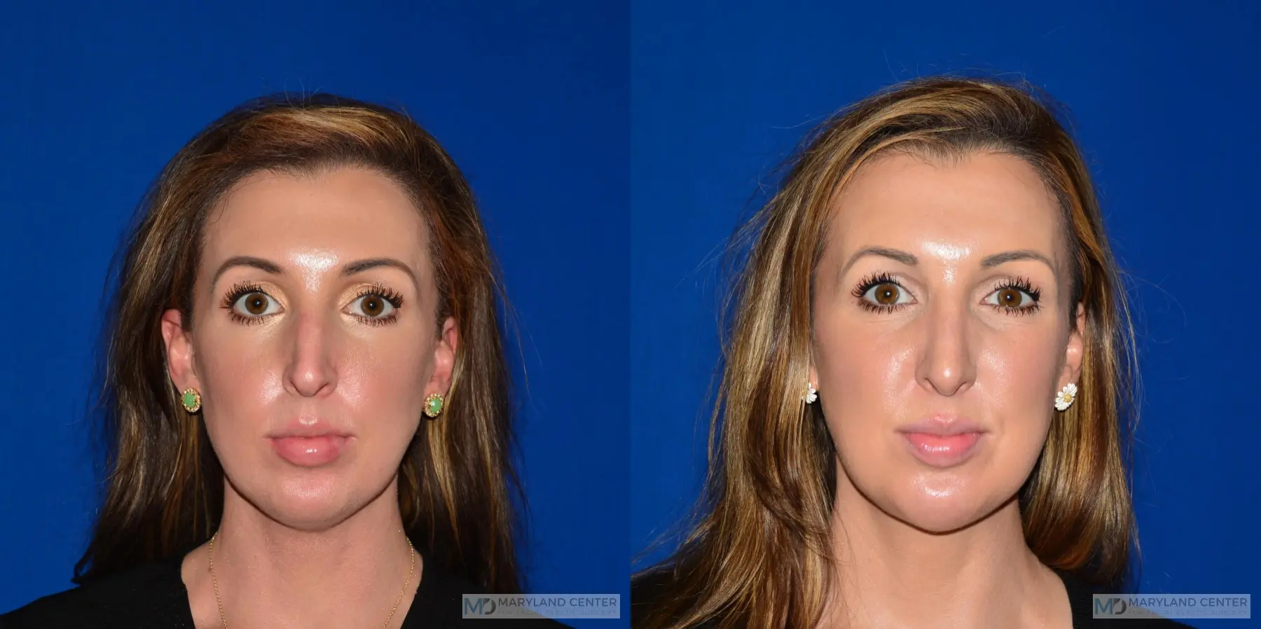 Rhinoplasty: Patient 2 - Before and After  