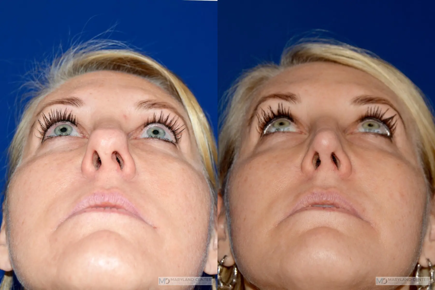 Rhinoplasty: Patient 15 - Before and After 3