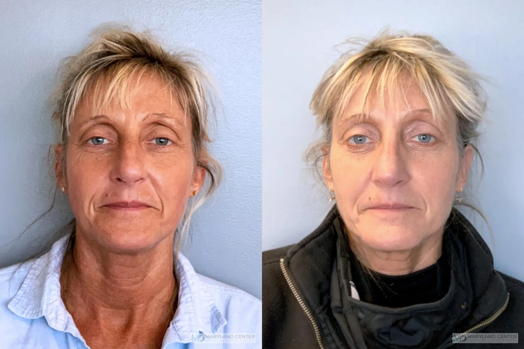 Rhinoplasty: Patient 18 - Before and After  