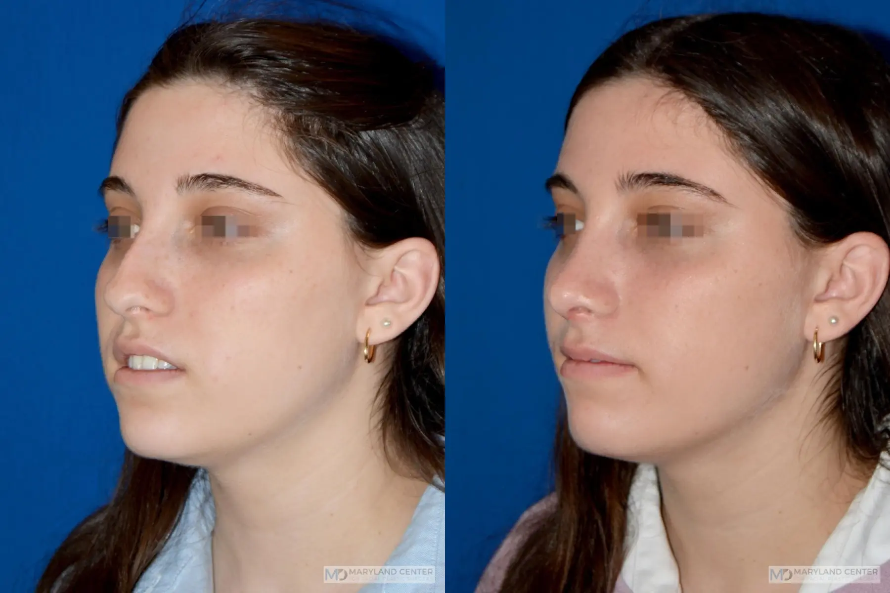 Rhinoplasty: Patient 17 - Before and After 3