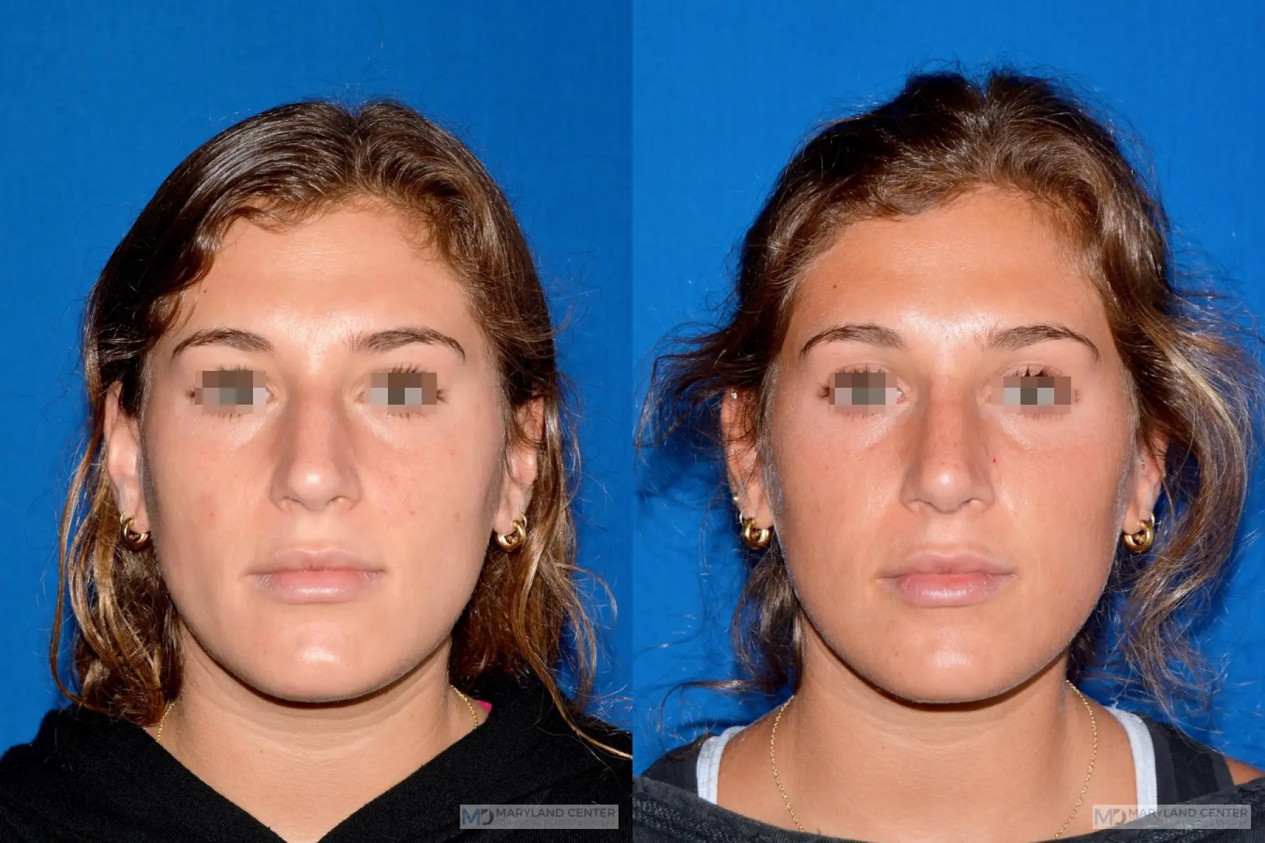 Rhinoplasty: Patient 9 - Before and After  
