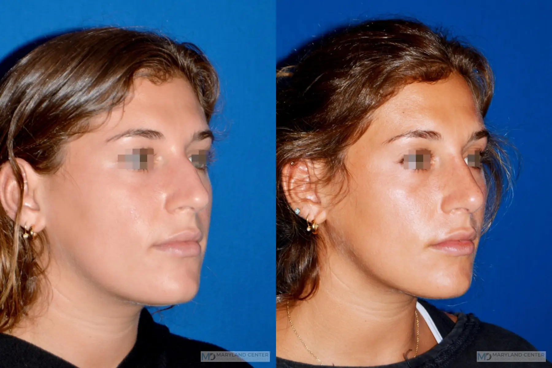 Rhinoplasty: Patient 9 - Before and After 3