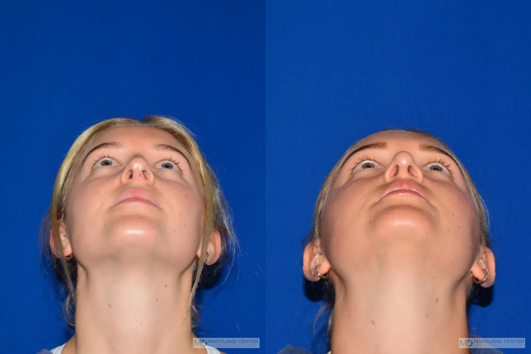 Rhinoplasty: Patient 7 - Before and After 2
