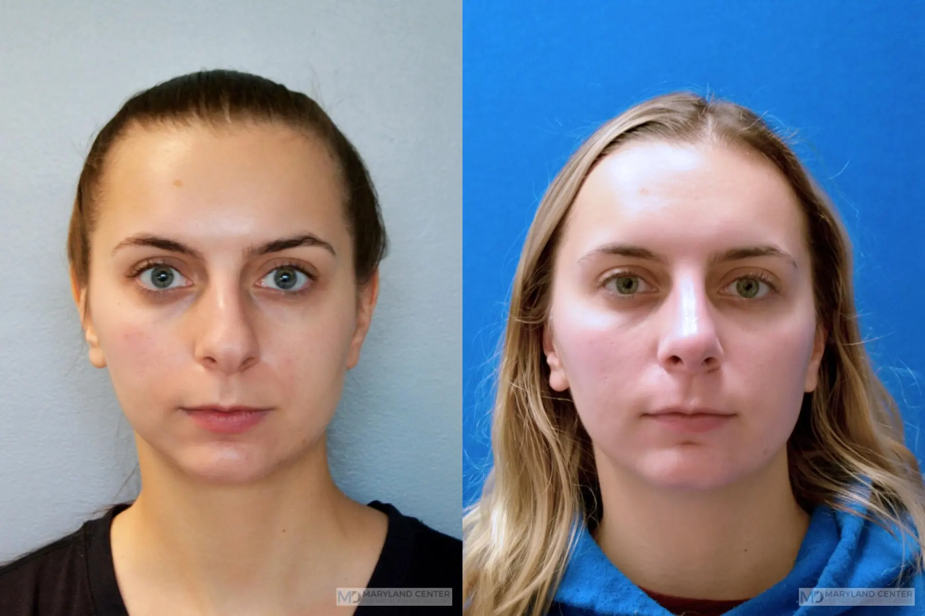 Rhinoplasty: Patient 6 - Before and After 1