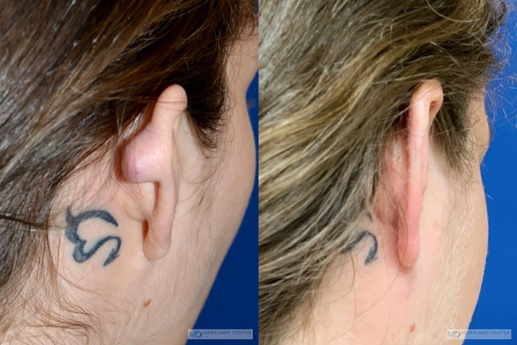 Scar Revision: Patient 1 - Before and After  