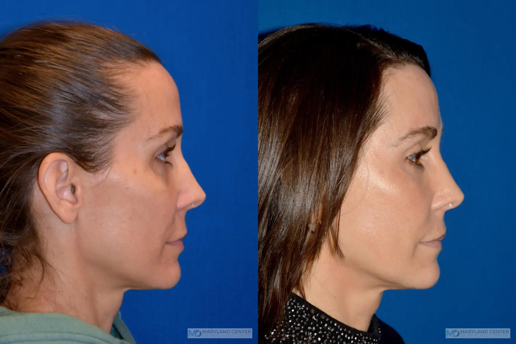 Sculptra®: Patient 1 - Before and After 2