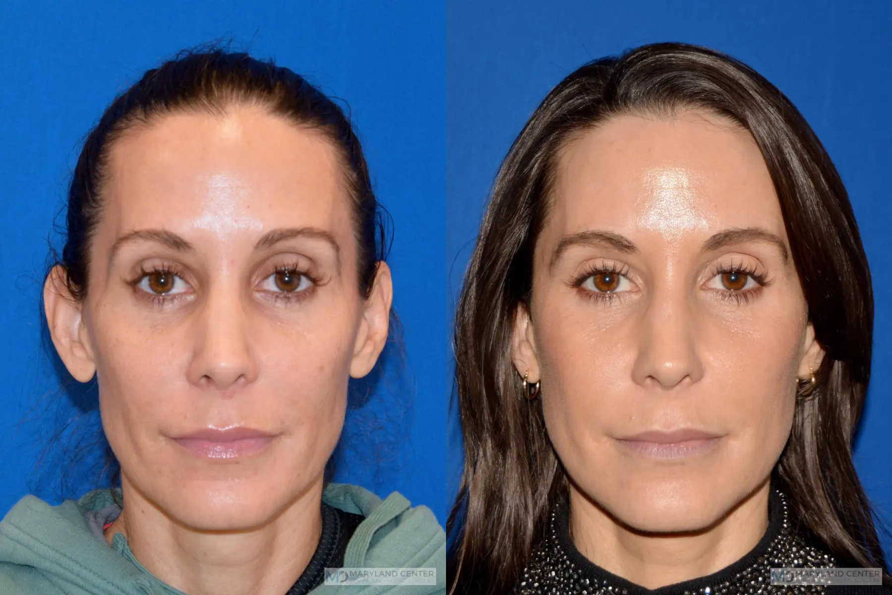 Sculptra®: Patient 1 - Before and After  