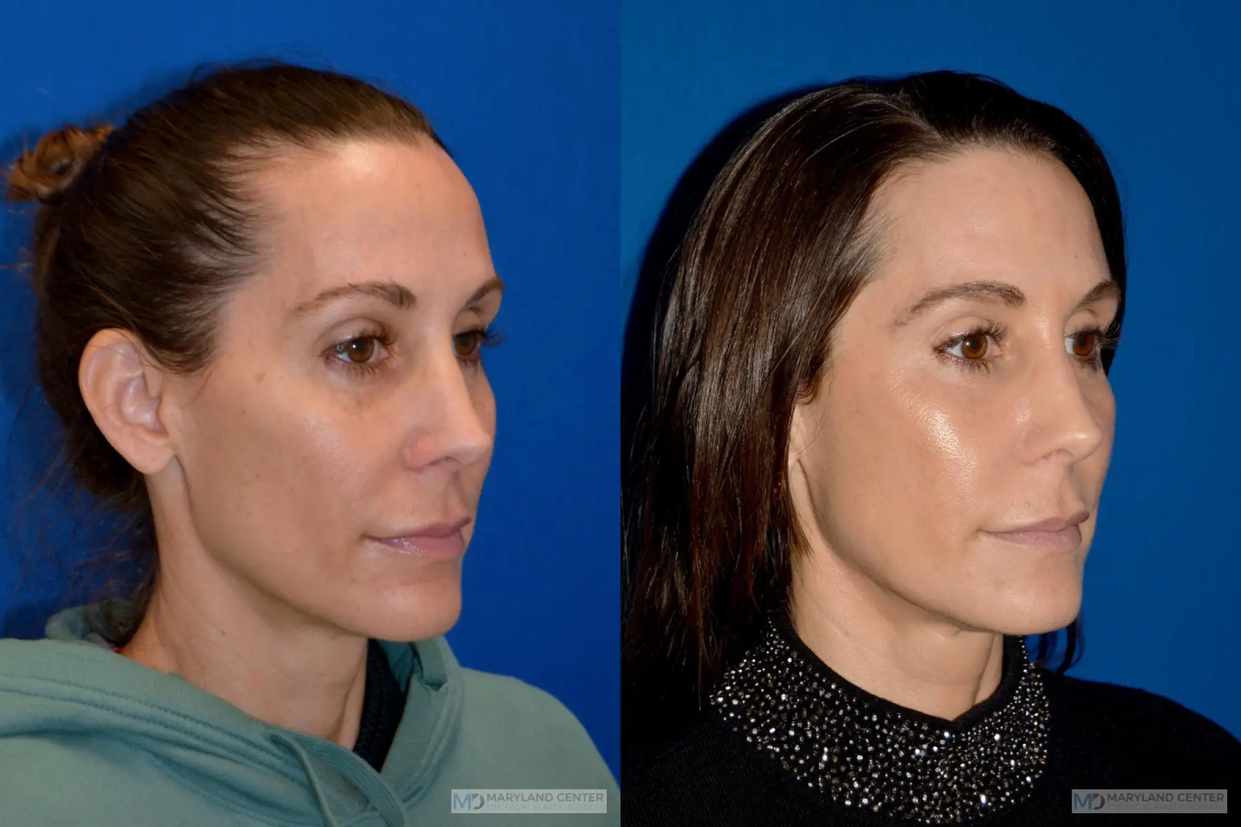 Sculptra®: Patient 1 - Before and After 3