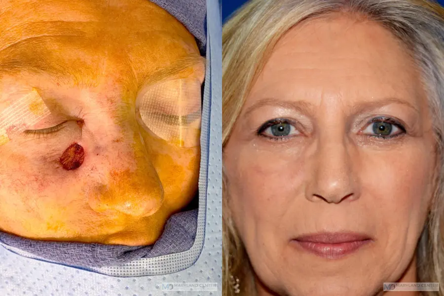 Skin Cancer Reconstruction - Face: Patient 1 - Before and After  