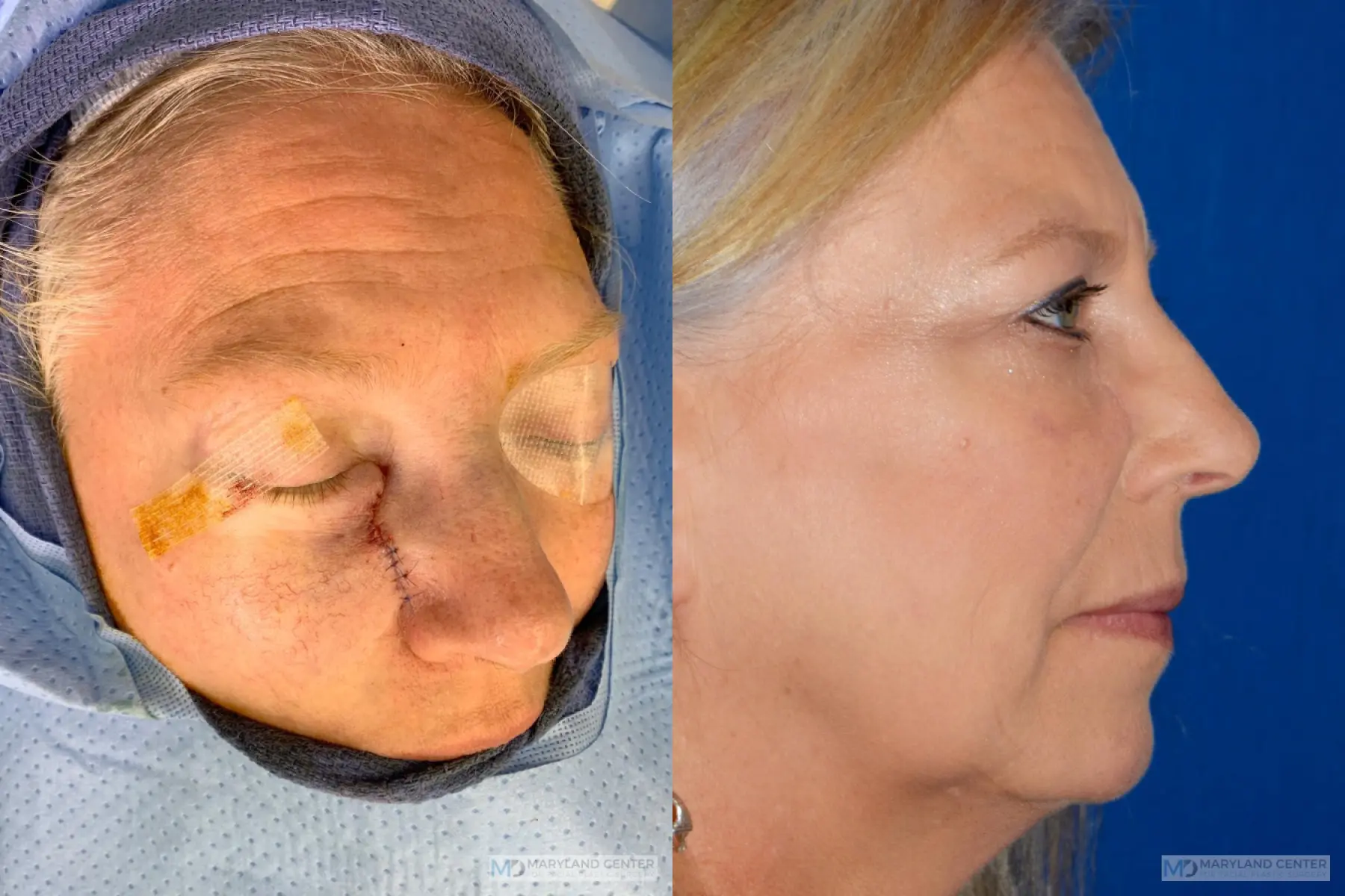 Skin Cancer Reconstruction - Face: Patient 1 - Before and After 3