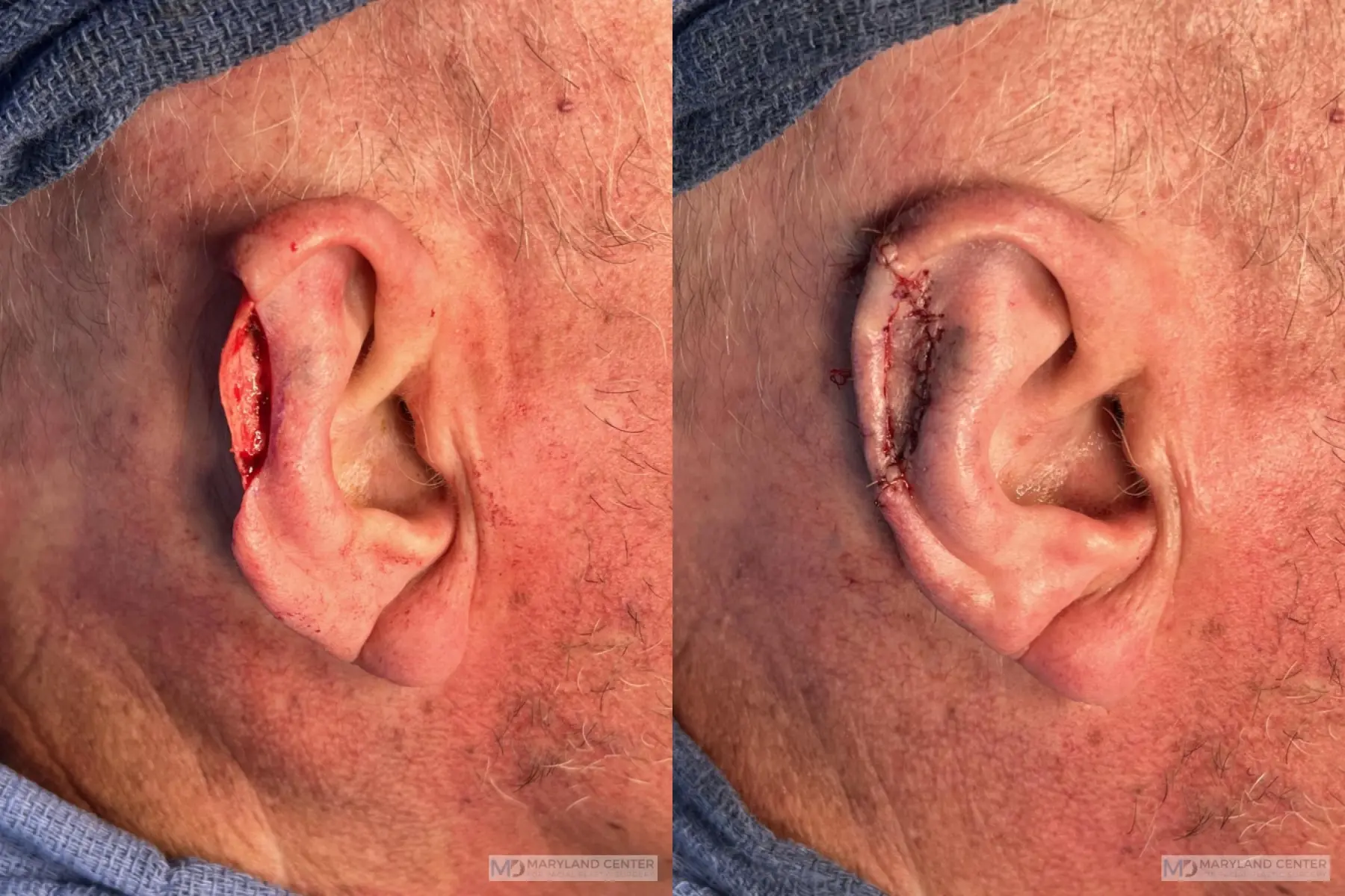 Skin Cancer Reconstruction - Face: Patient 2 - Before and After  